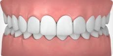 Parker Orthodontics - Overbite - illustrated example